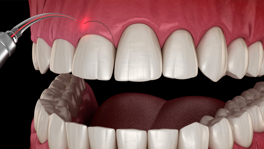 img-treatment-gingivectomy-02